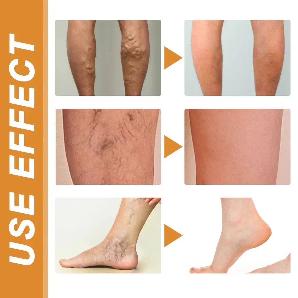 Varicose Veins Spray – Natural Herbal Formula for Fast Relief I Buy 1 Get 1 Free